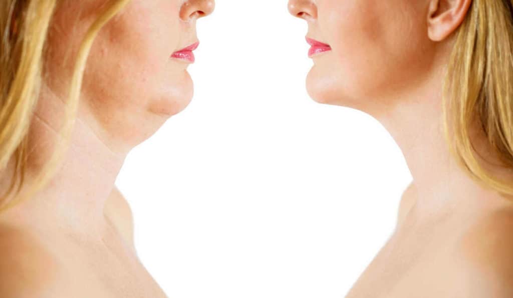 Double Chin treatment Bicester before and after results