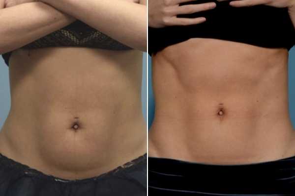 body sculpting FAQs Bicester