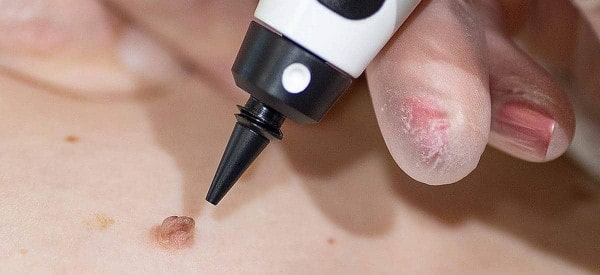 After Skin Tag Removal Bicester