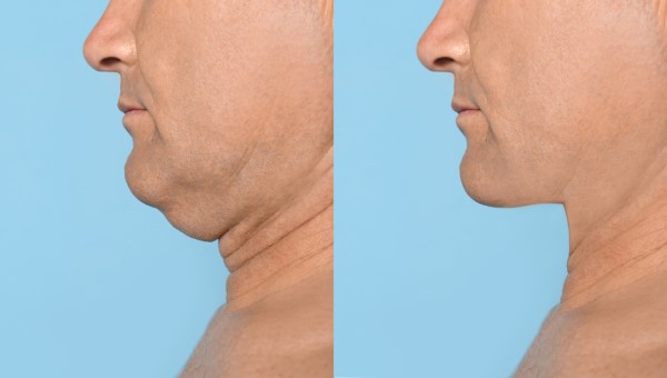 Which Non-Surgical Treatments Work Best for Jowls and Loose Skin Bicester?