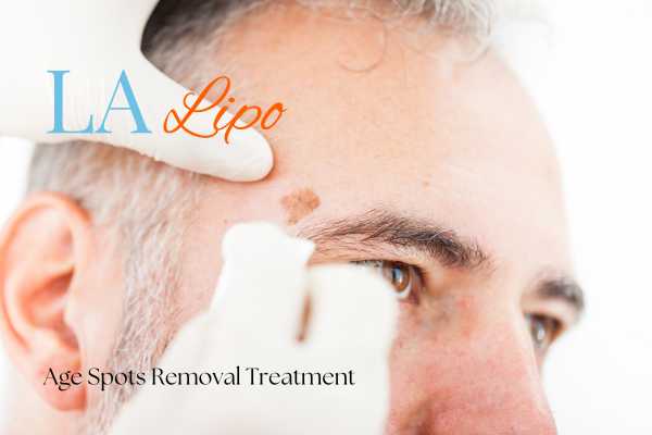 What Are the Most Effective Treatments for Age Spots Bicester?