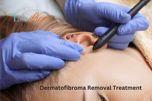Dermatofibroma Removal Treatment Bicester