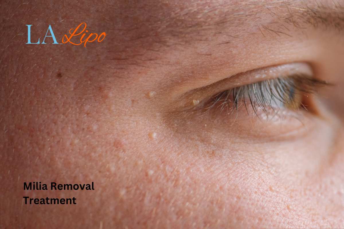 Cryopen Milia Removal: Is It the Easiest and Safest Option Bicester?