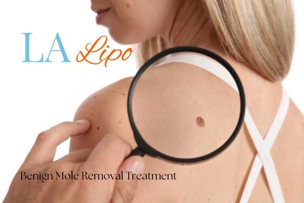 Why getting moles removed Bicester can boost your confidence!