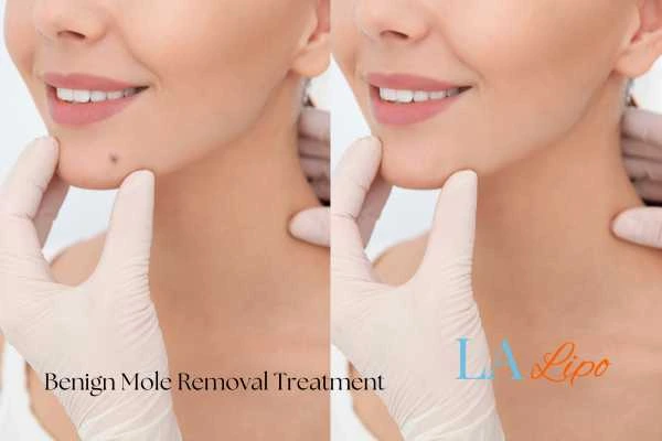 Woman's before and after results of being moles removal treatment Bicester