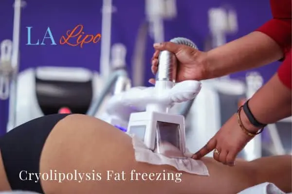 women getting fat freezing Bicester