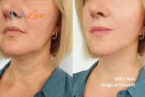 hi-fu for wrinkles Bicester before and after results