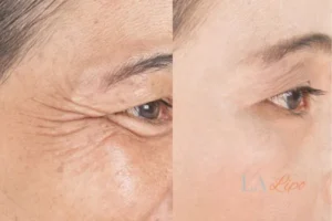 Before and after results of woman - HI-fu wrinkles reduction treatment Bicester