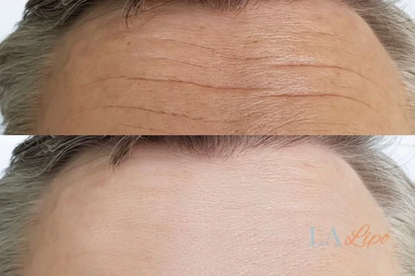 results of HIFU Bicester on mans forehead to help reduce lines and wrinkles