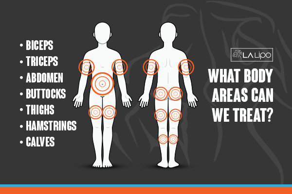 Graphic to show areas you can have LA-EMS Body Sculpting Bicester treatment.