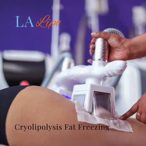 fat freezing - Cryolipolysis Bicester