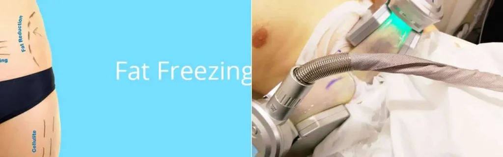 multi areas of a persons body having coolsculpting Bicester treatment