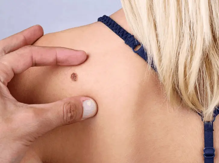 woman having mole removal Bicester consultation before treatment.