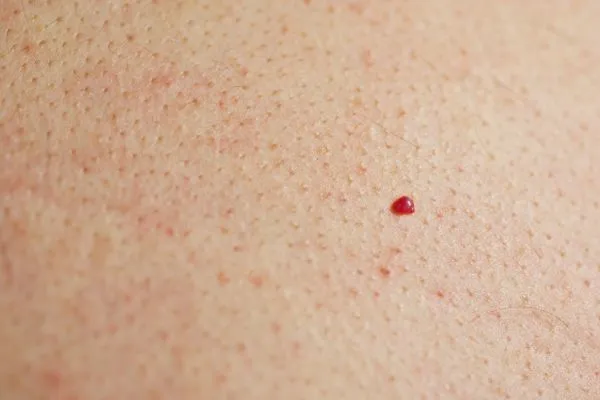close up of a cherry angioma Bicester