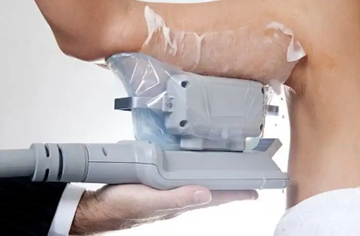 Picture of fat freezing Bicester on the upper arms.