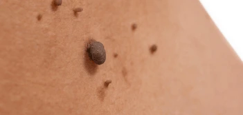 image of a skin tag Bicester
