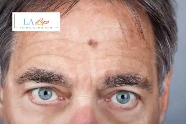 Solar Lentigo Removal Bicester image of man with mark on his forehead