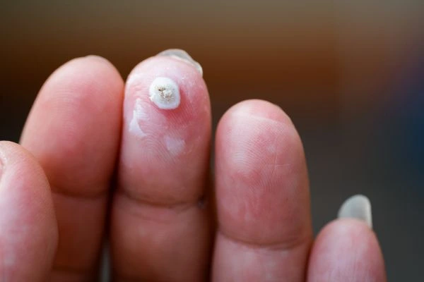 wart on person finger - cryotherapy to treat from LA LIPO Bicester