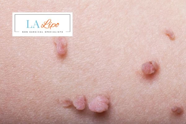 Does cryopen skin tag removal Bicester hurt? Find out now call our team today!