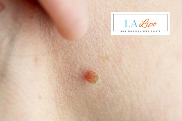 Book skin tag removal Bicester today speak to our team now!