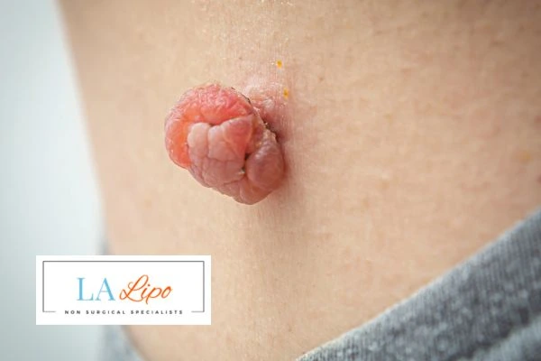 Interested in skin tag removal Bicester? Concerned about the pain? Find out more today!