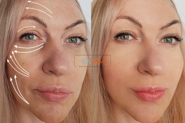 Morpheus 8 results Bicester face lift.