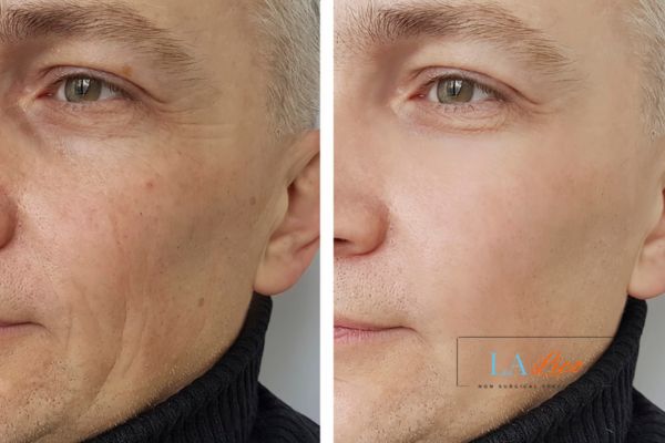 See the amazing results of Morpheus8 Treatment Bicester!