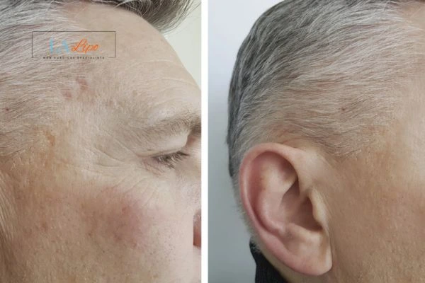 Mens Before & After Morpheus 8 Results Bicester