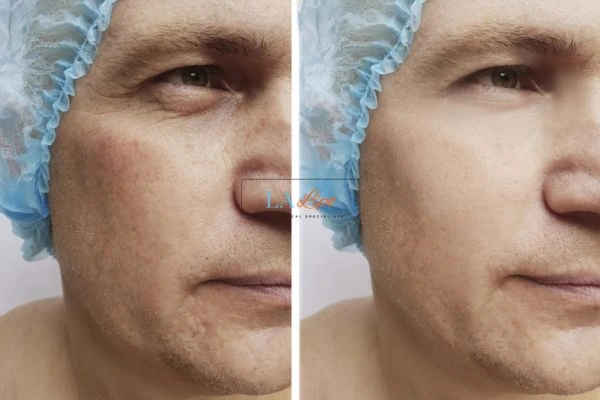 Before and after Morpheus 8 Results Bicester