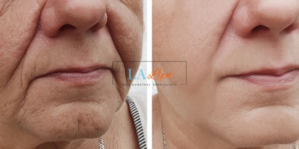 Older lady deeper wrinkle reduction - LA LIPO Morpheus 8 Results Bicester
