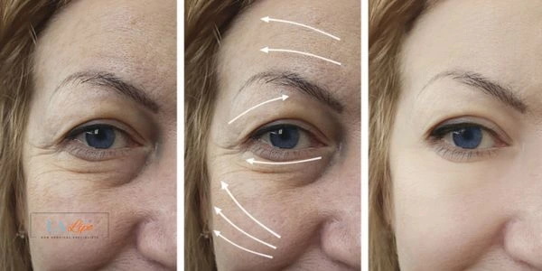 Amazing eye lift Morpheus 8 results Bicester