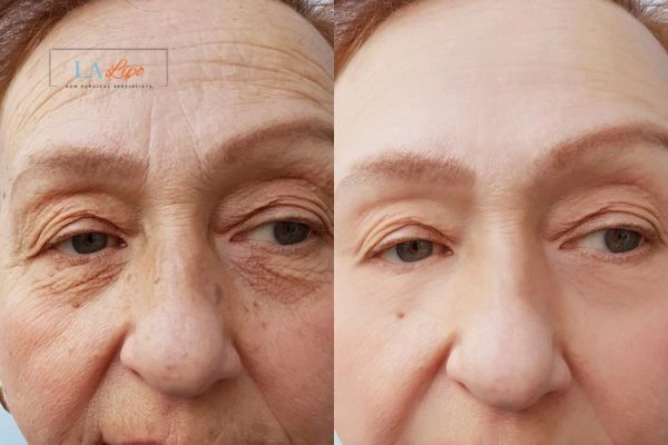 The powerful benefits of Morpheus8 Treatment Bicester - Call Our team today!