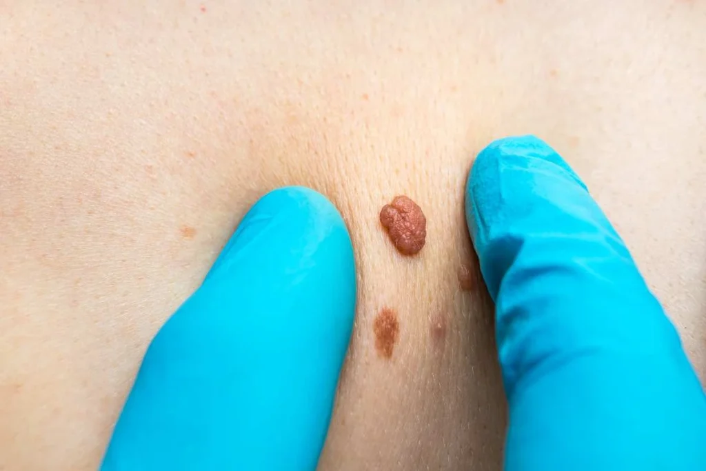 LA LIPO Cryopen Lesion Removal Prices Bicester