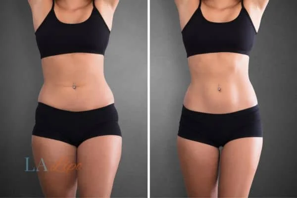 before and after results of non-surgical treatment to help a woman's body image and mental health Bicester