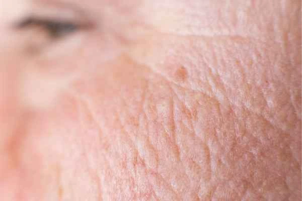 close up picture of a woman's face showing an age spot Bicester