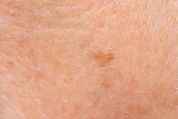 close up picture of age spots Bicester