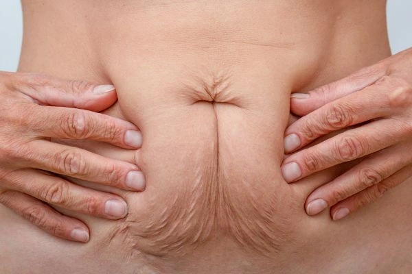 Image of a woman's stomach with loose skin - example of skin tightening Bicester options