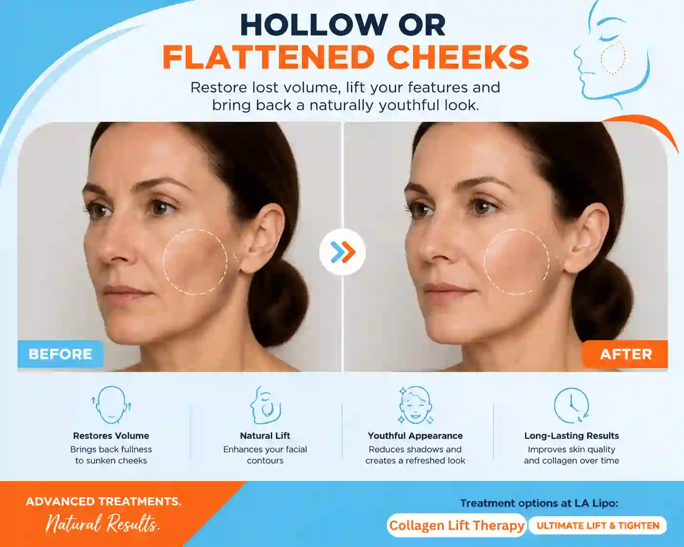 Sign #4: Hollow or Flattened Cheeks Bicester
