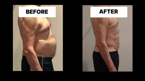 What Symptoms Can Diastasis Recti Cause in Men? Weak Core, Back Pain and Poor Posture Bicester